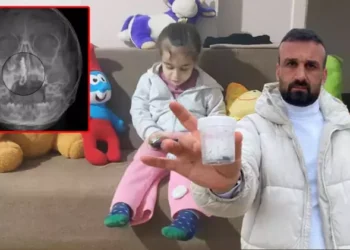 2 yıl burnunda tırnak makası zinciriyle yaşamış