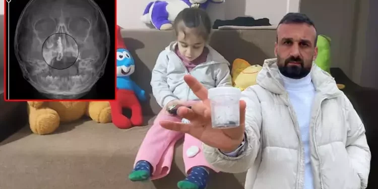 2 yıl burnunda tırnak makası zinciriyle yaşamış