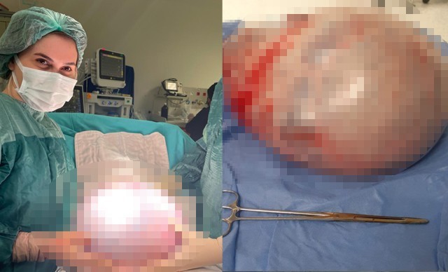 Karnından 9 kiloluk tümör çıktı