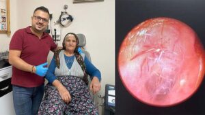Manisa‘da ses şikayetiyle hastaneye başvuran Fatma Arık’ın (72) kulağında örümcek