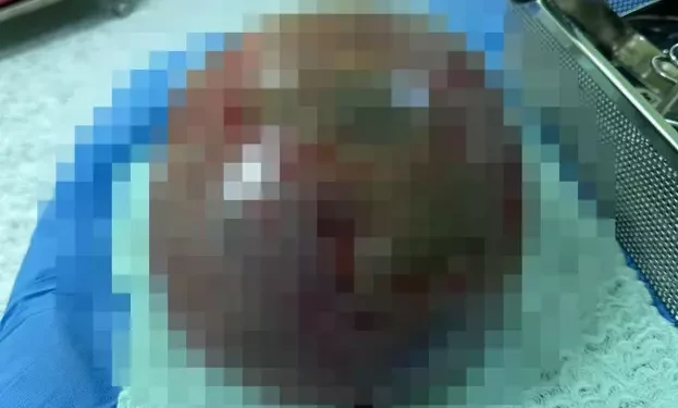 Karnından 10 kiloluk kitle çıktı