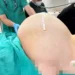 Yumurtalıklarında 23 kiloluk kitle operasyonla çıkarıldı