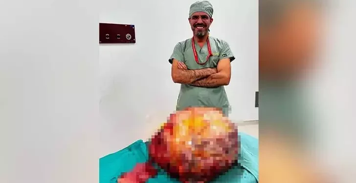 Karnından 26 kiloluk tümör çıktı