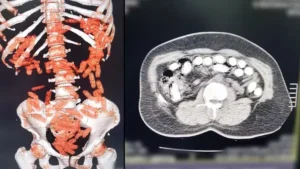 Midesinden yaklaşık 1 kilo uyuşturucu çıktı