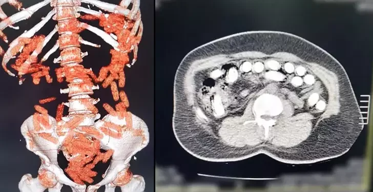 Midesinden yaklaşık 1 kilo uyuşturucu çıktı