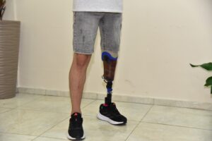  Berkay’ın bacak protezinin değişmesi için 160 bin TL lazım