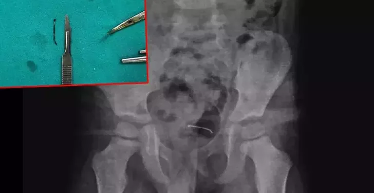 5 yaşındaki çocuğun yuttuğu toplu iğne, ameliyatla çıkarıldı